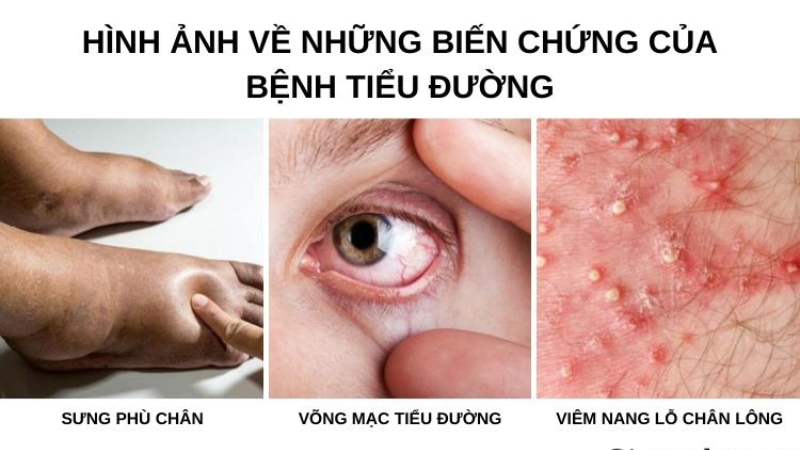 biến chứng của bệnh tiểu đường